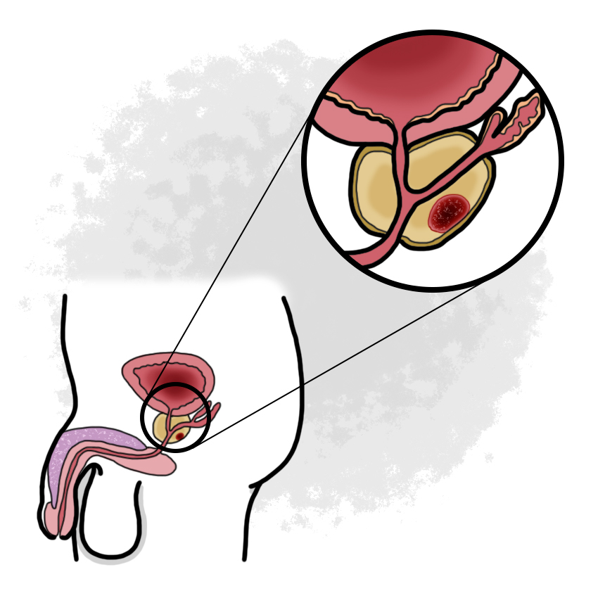 Prostatic neoplasm