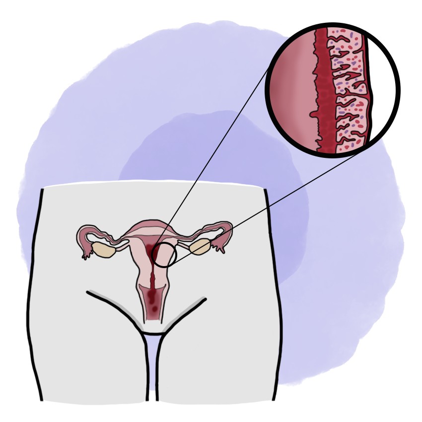 Uterine atony