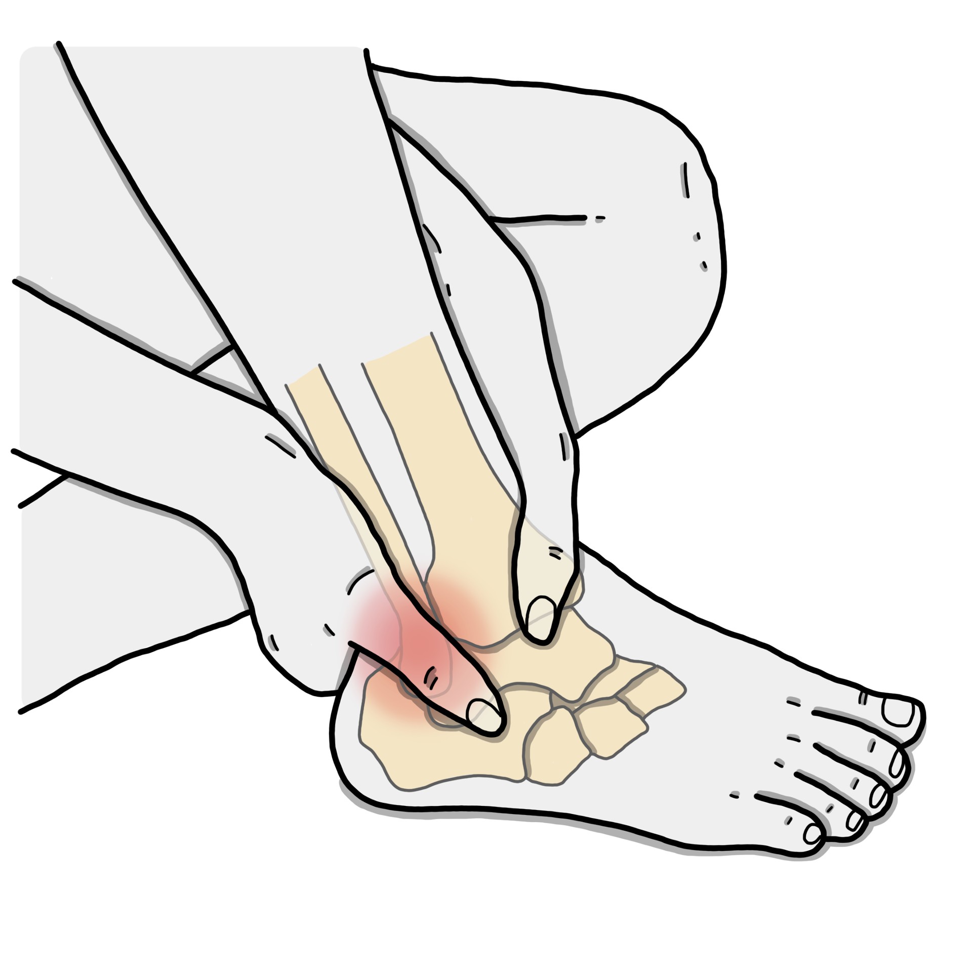 Pijn aan de buitenkant van de enkel, in de regio van de peroneus malleolus