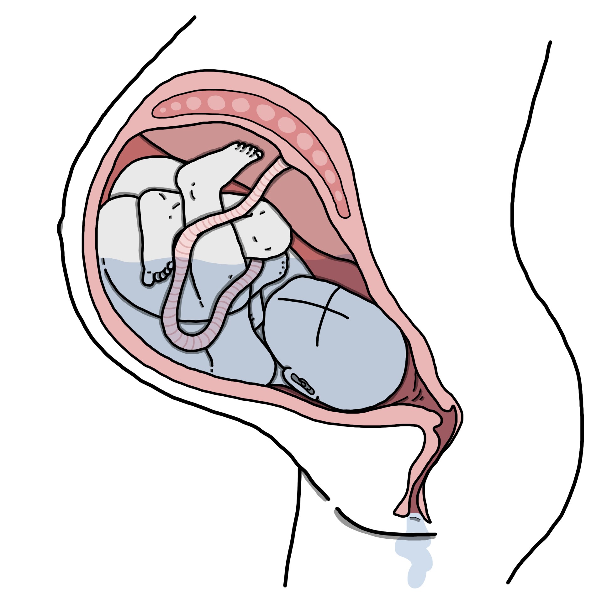 Premature rupture of membranes