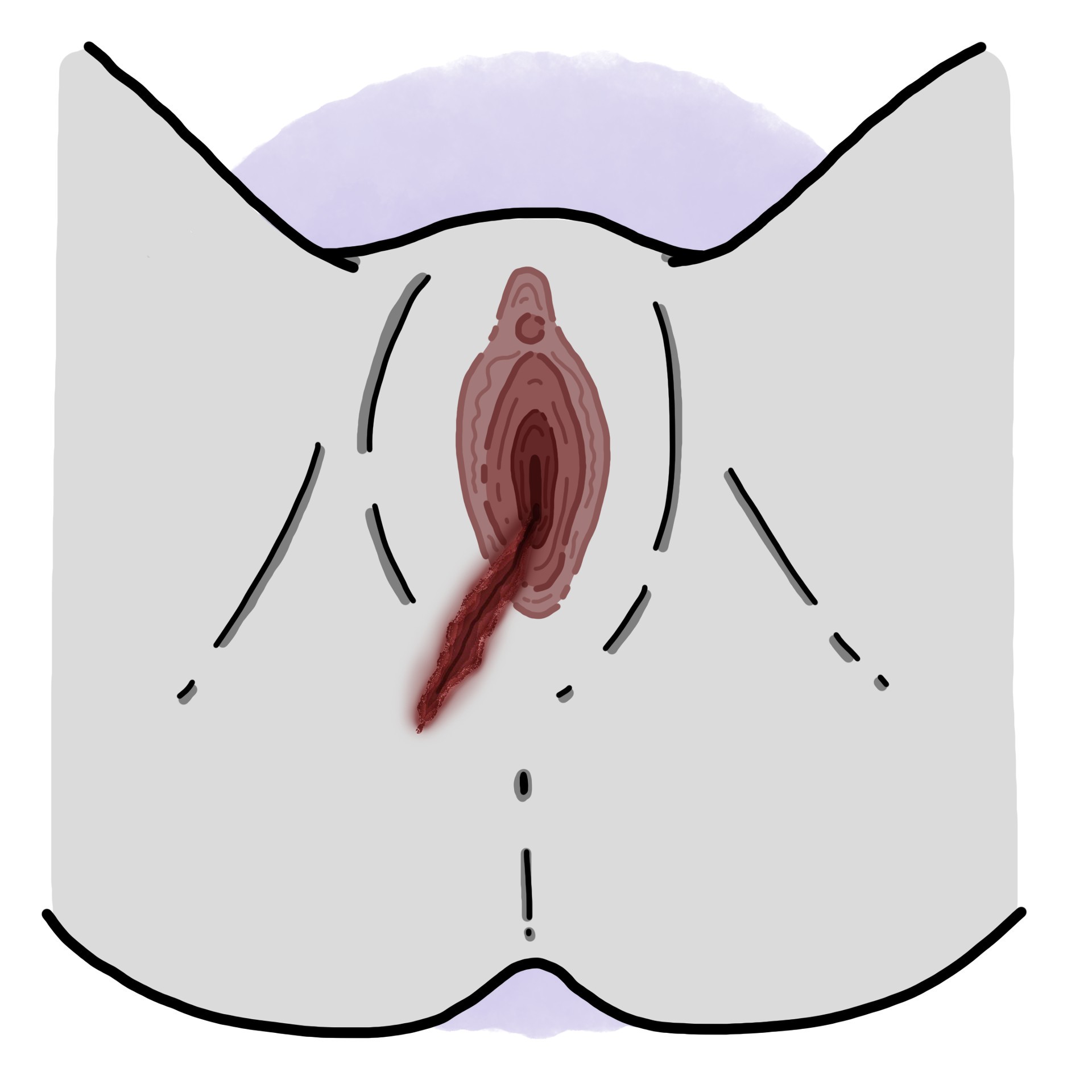 Spontaneous episiotomy dehiscence
