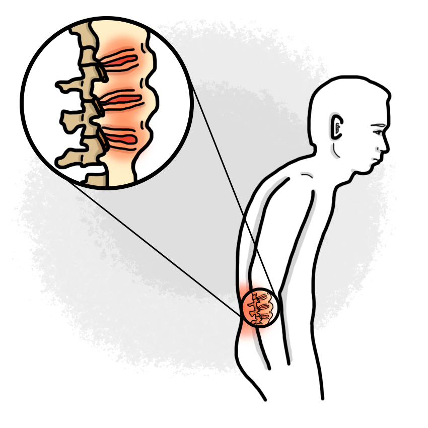 Ankylosing spondylitis