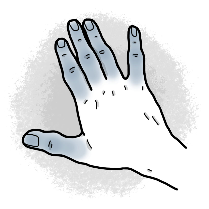 Second-degree frostbite