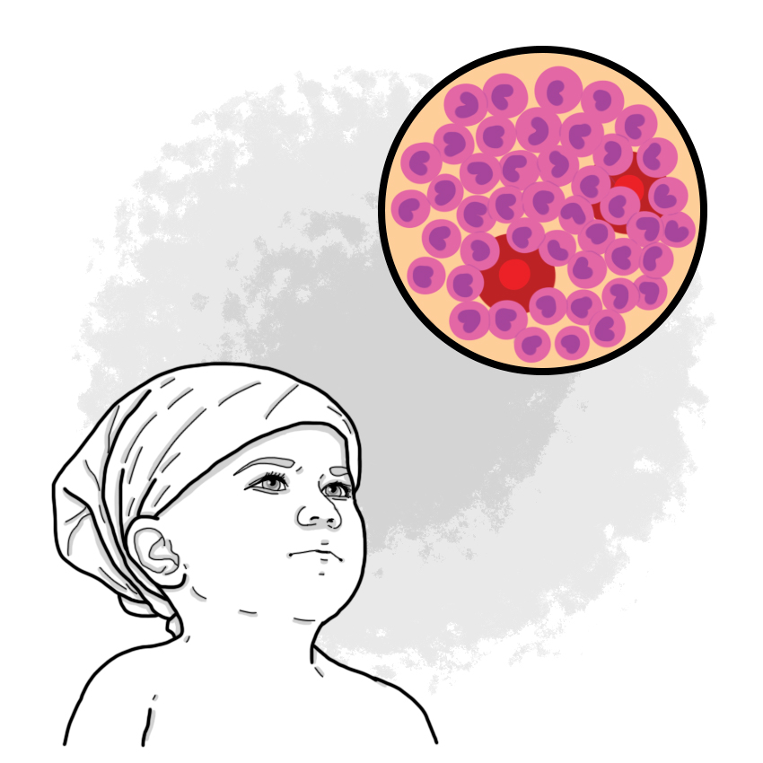 Acute leukaemia (Paediatrics)