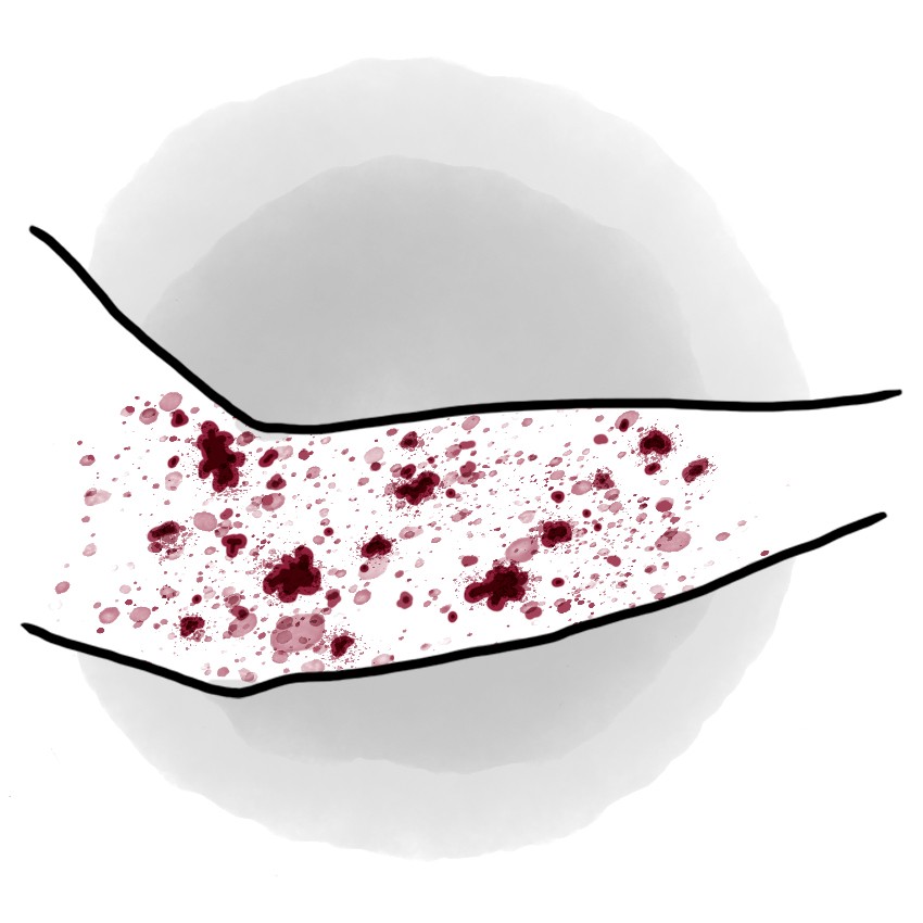 Immune thrombocytopaenic purpura - ITP (Paediatrics)