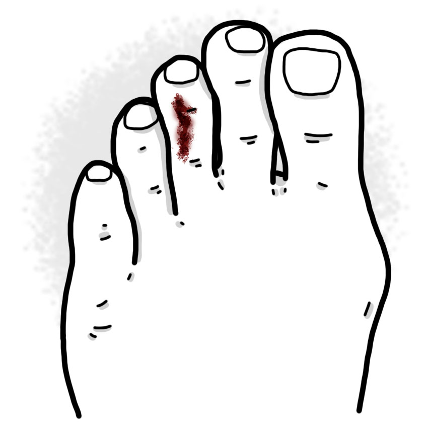 Toe wound