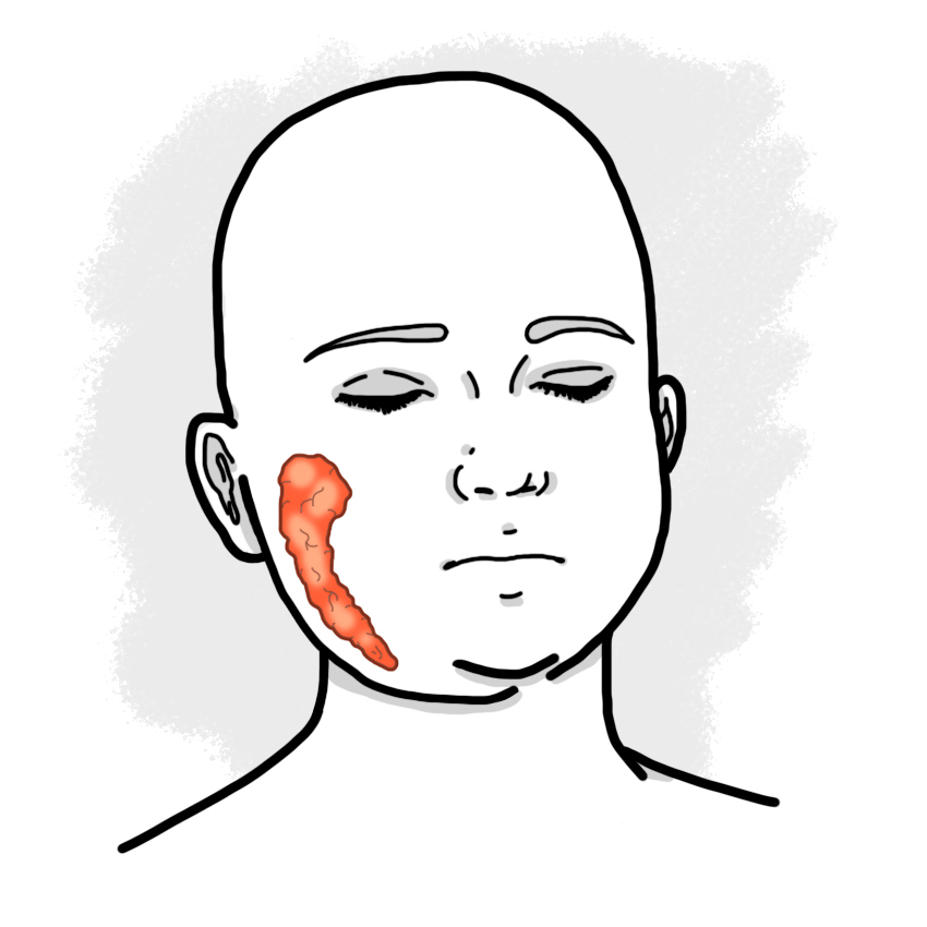 Mumps - Parotitis (Paediatrics)
