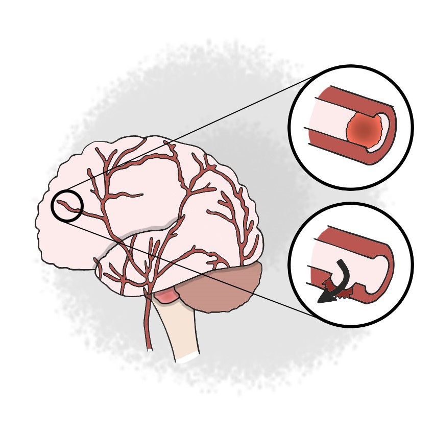 Stroke - Anterior cerebral artery