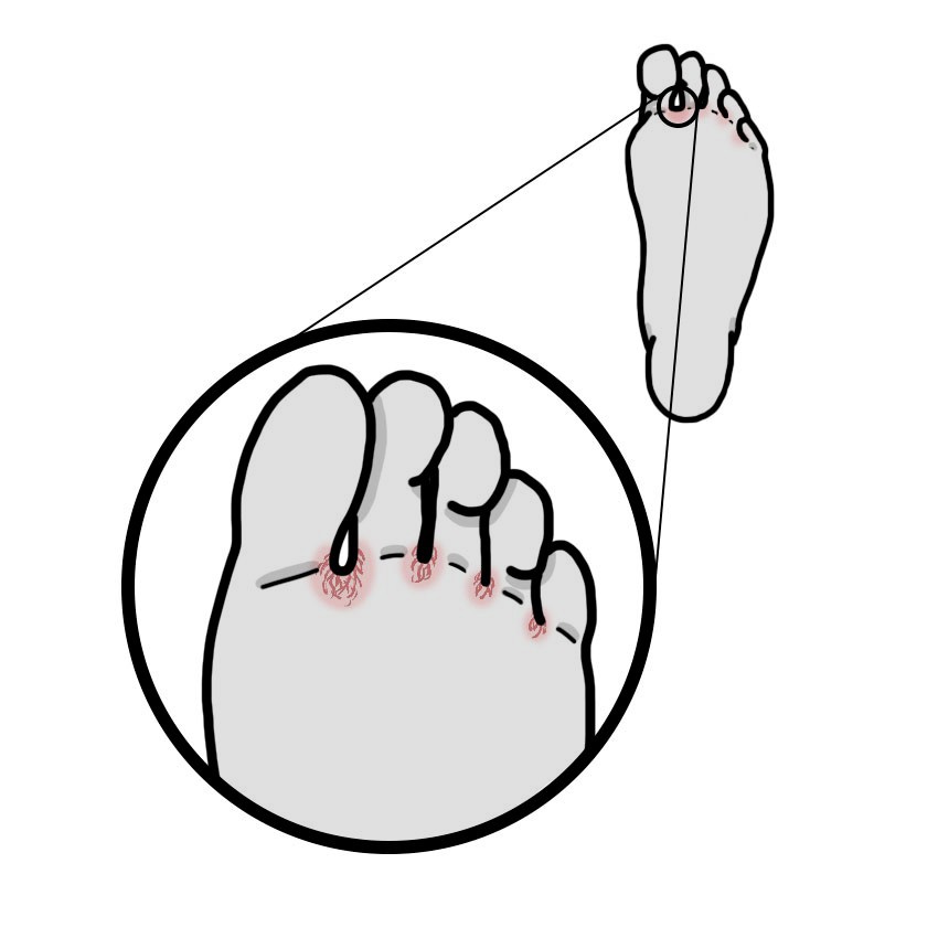 Cracked skin between toes