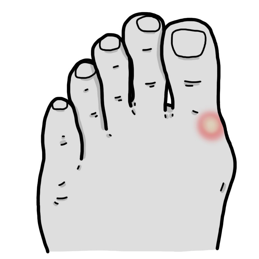 Callo dedo gordo del pie