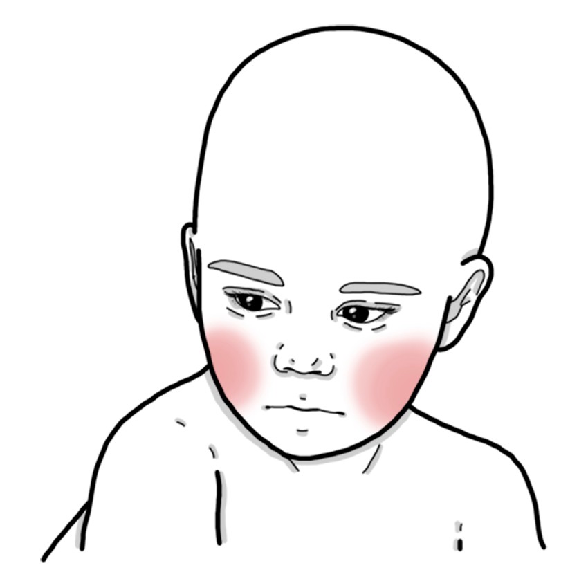 Infectious erythema / Megaloerythema / 5th disease / Slapped cheek disease (Paediatrics)