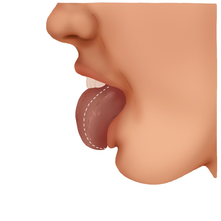 Tongue swelling - Glossitis