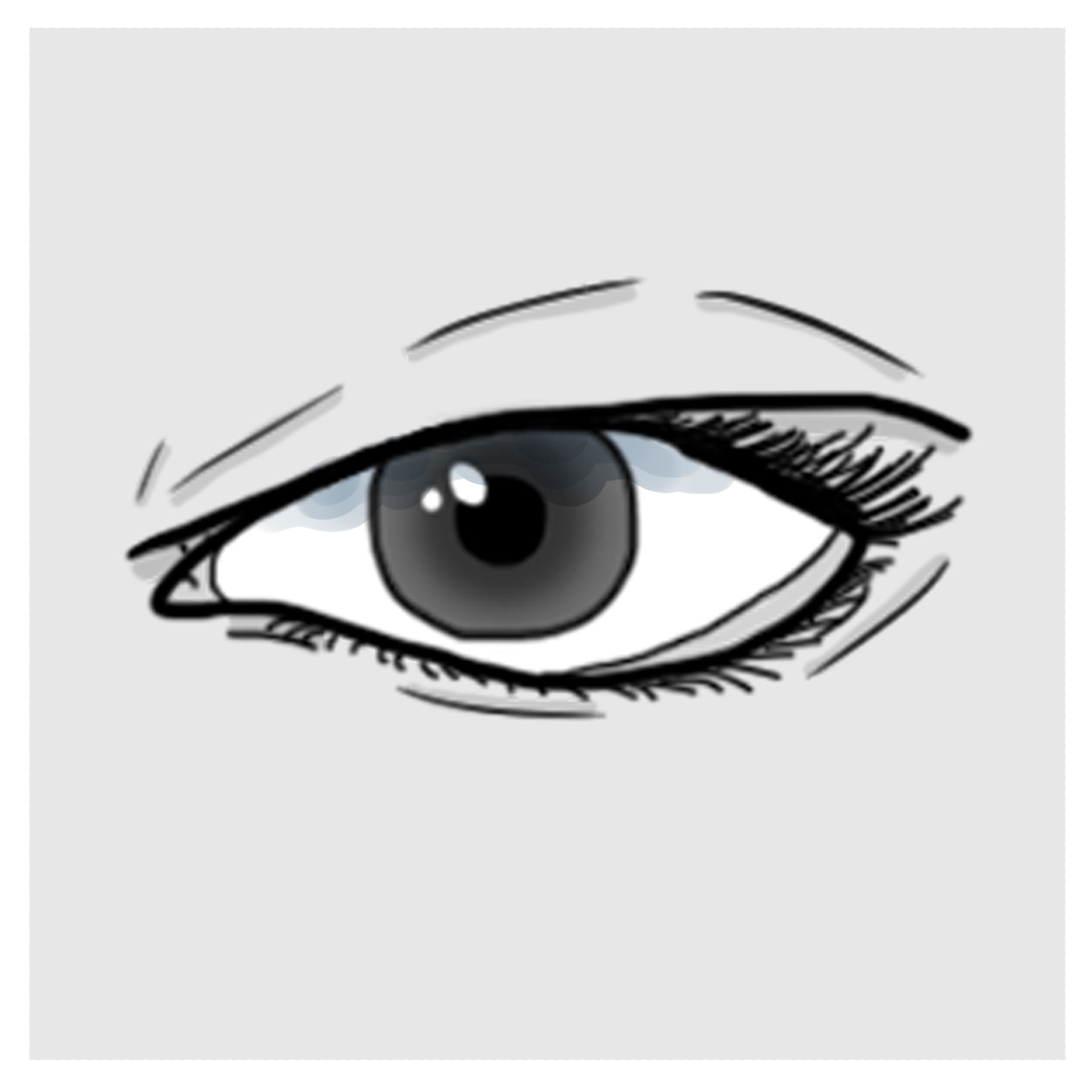 Quemosis conjuntival