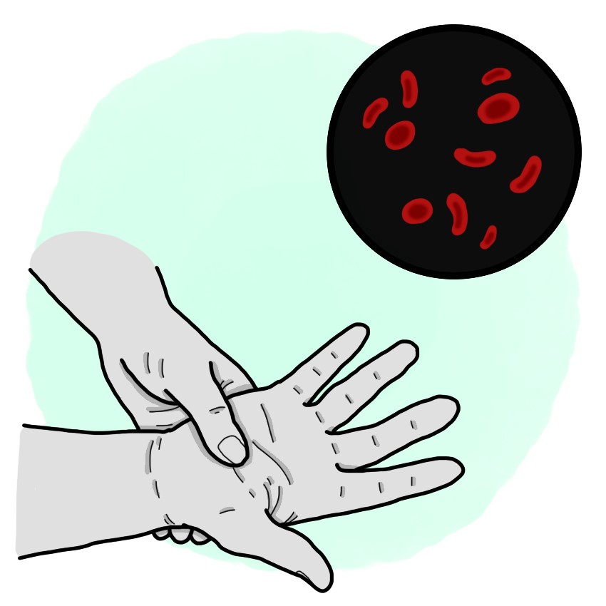 Sickle-cell anaemia - Sickle-cell disease (Paediatrics)