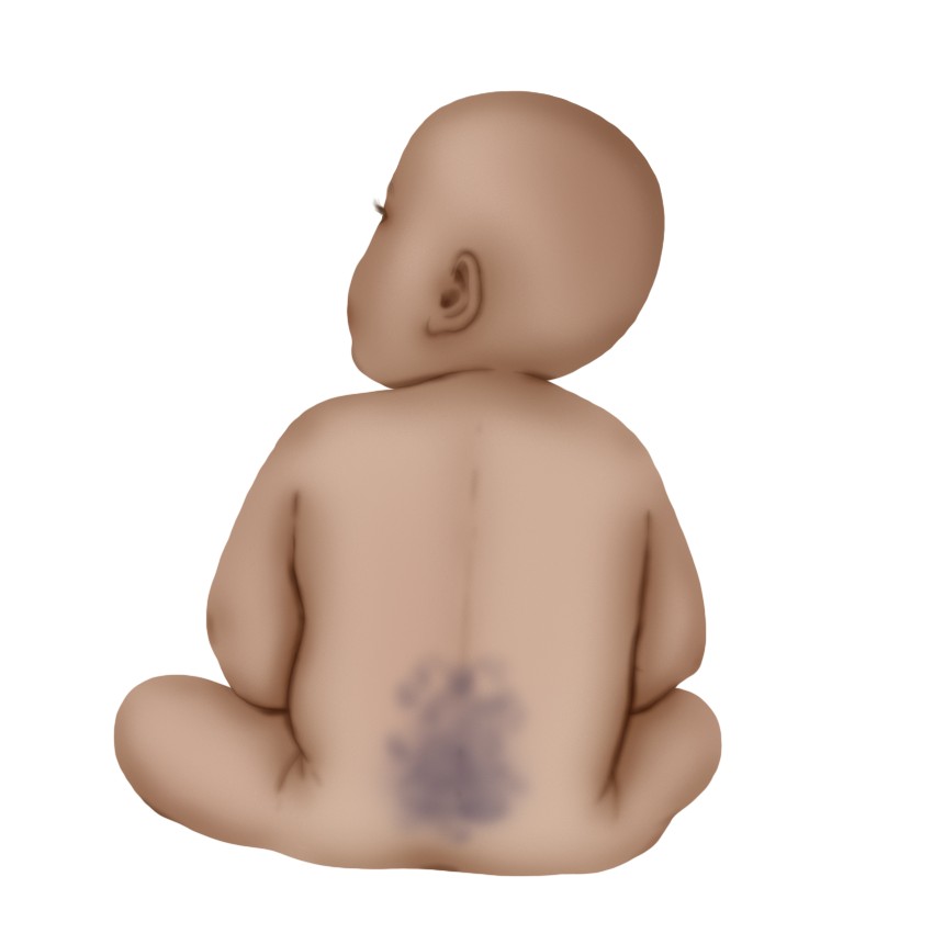 Mongolian blue spot (Paediatrics)