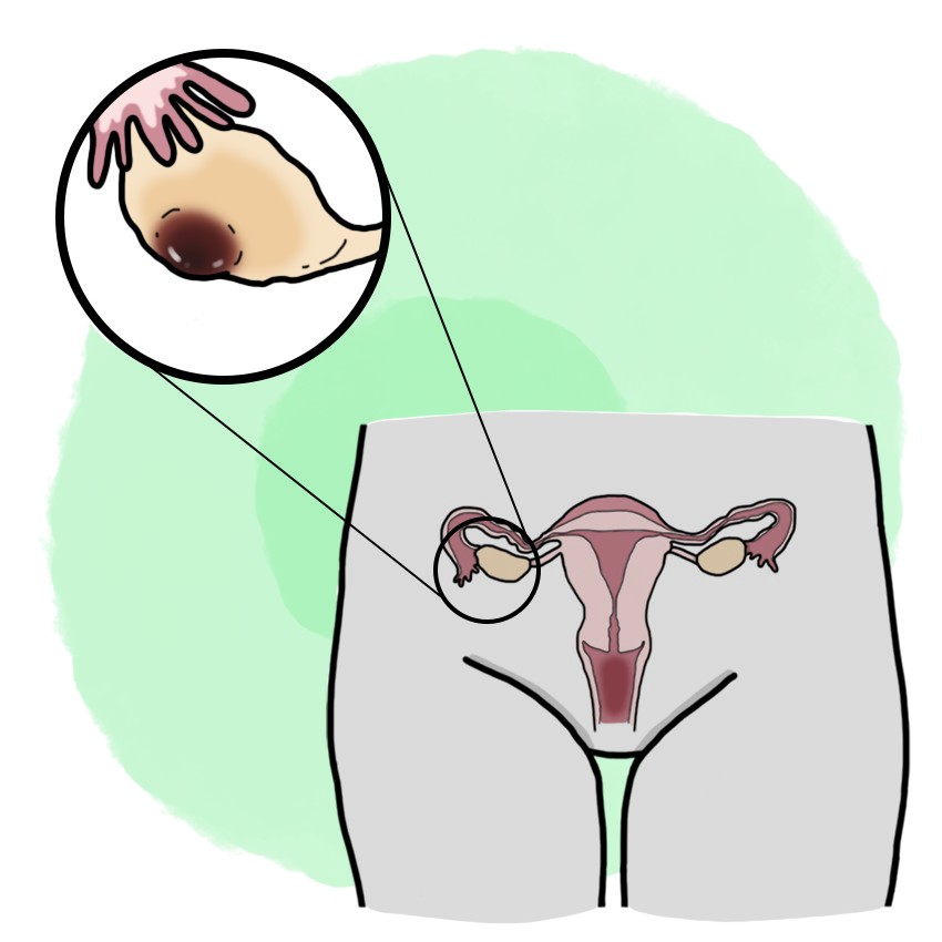 Haemorrhagic corpus luteum