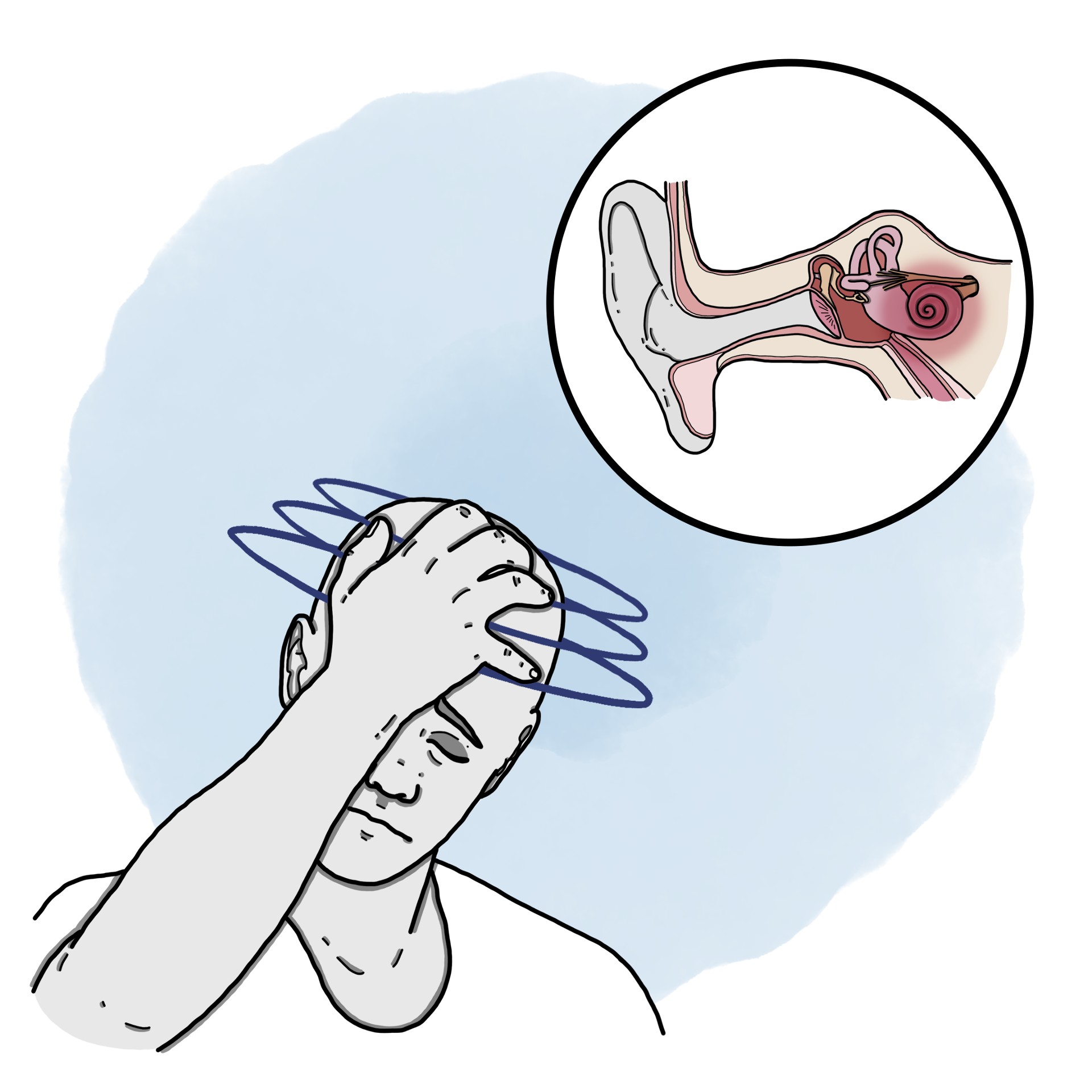 Peripheral vertigo due to labyrinthitis