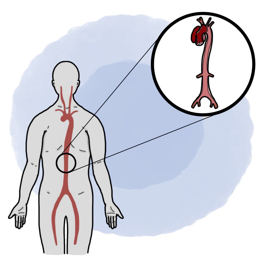 Type-A aortic dissection - Proximal