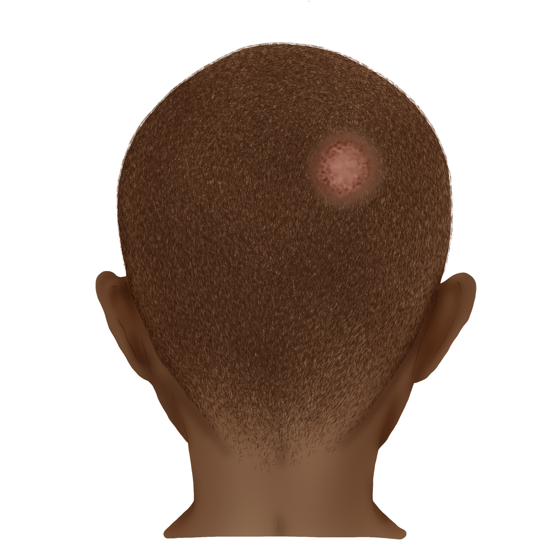 Scalp ringworm - Tinea capitis (Paediatrics)