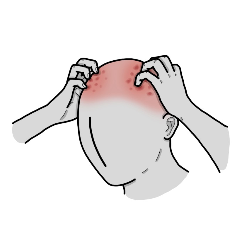 فروة الرأس بها إصابات بسبب الحك