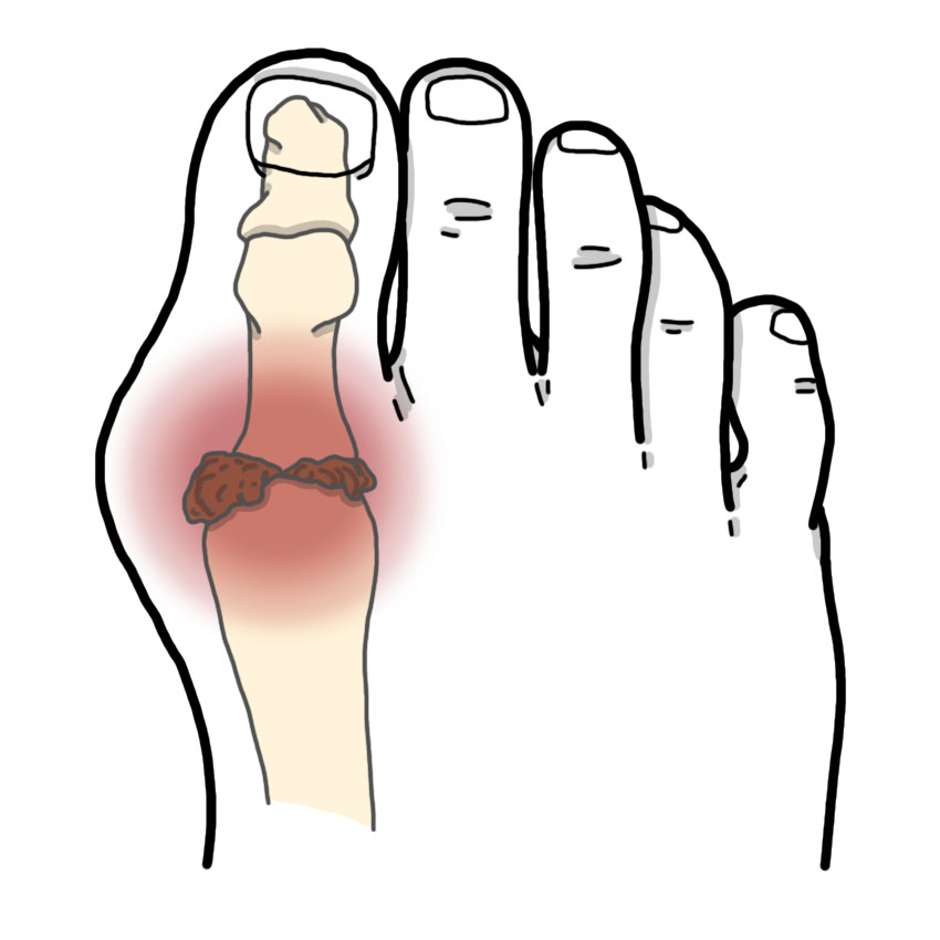 Gout - Gouty arthritis