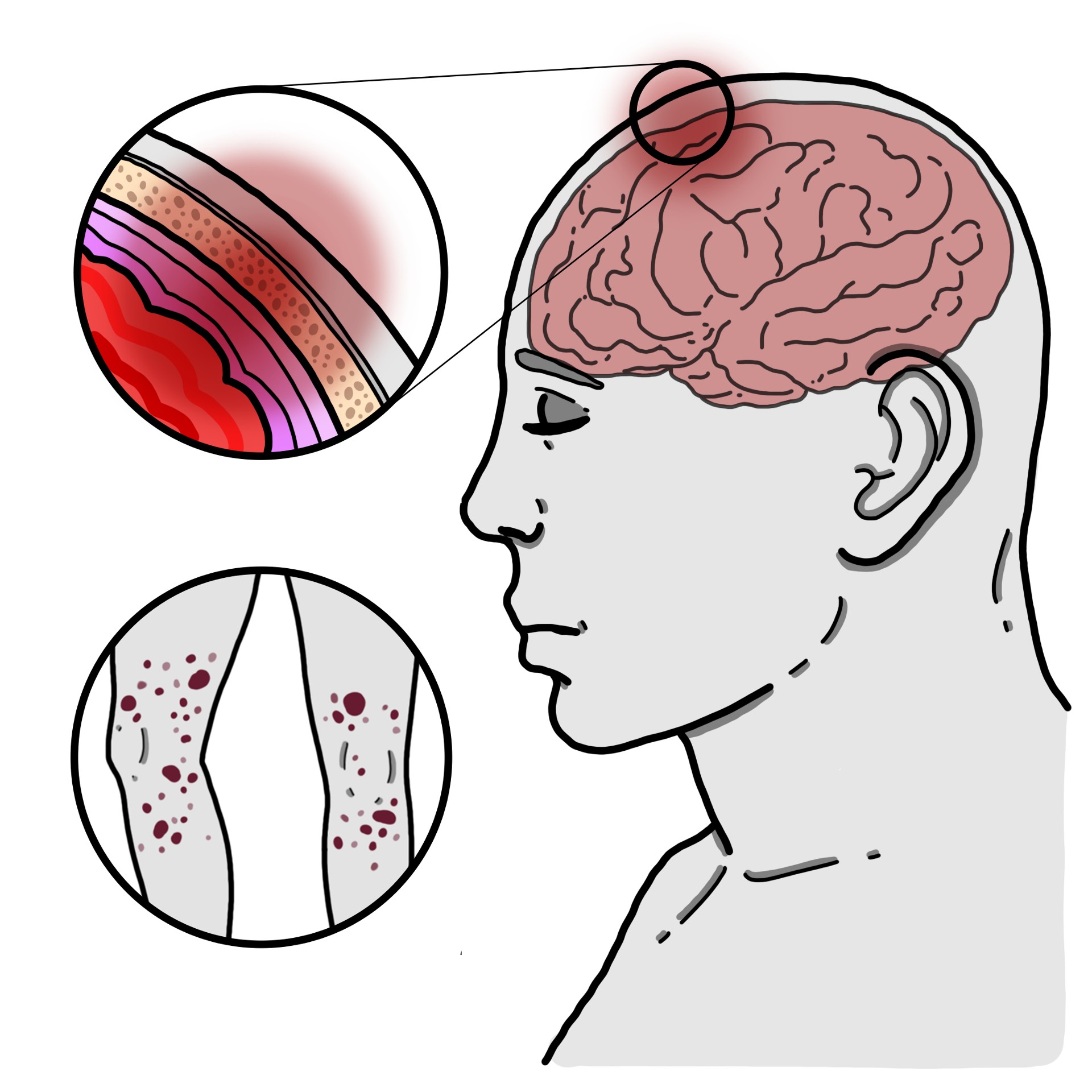 Meningococcal meningitis
