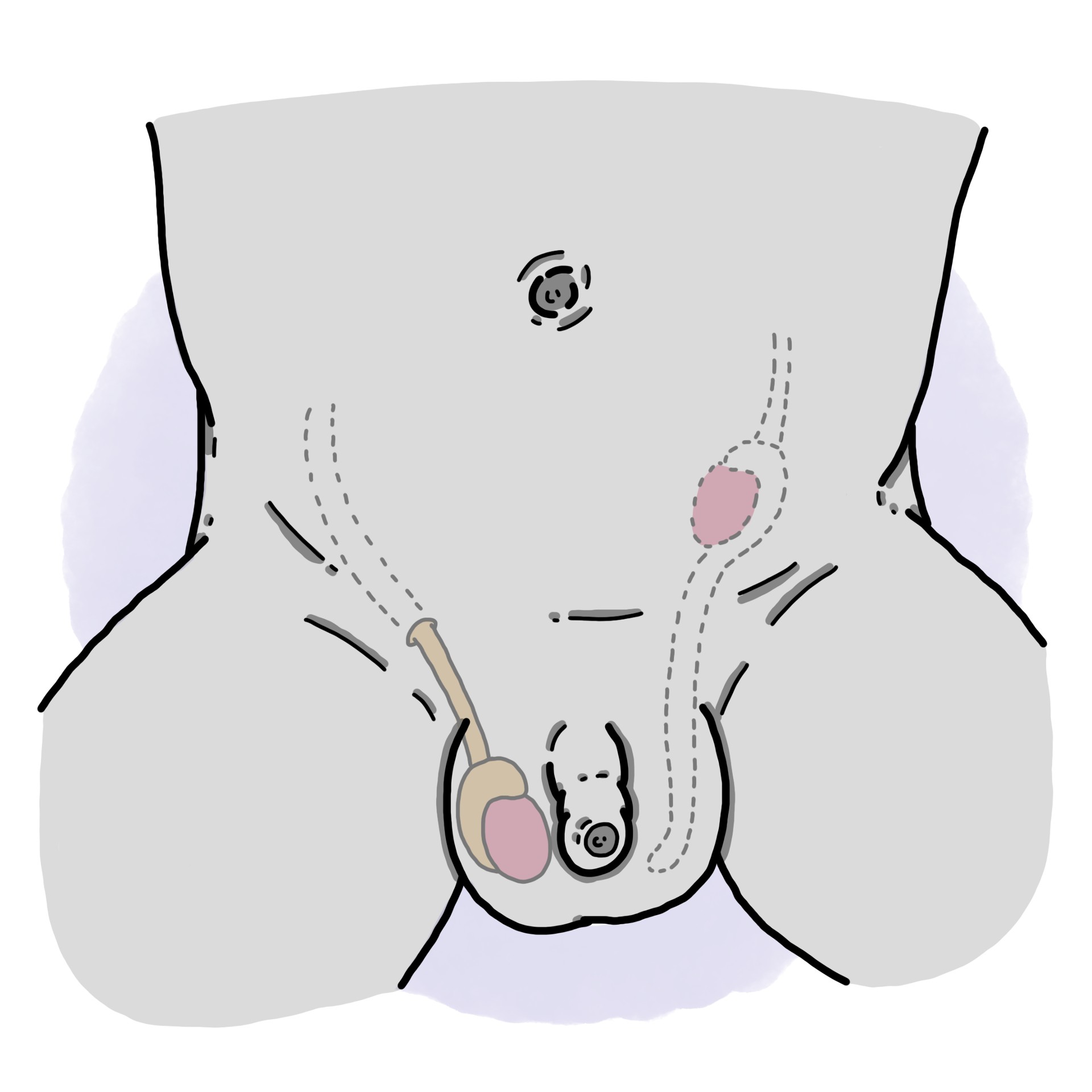 Cryptorchidism - Undescended testicle (Paediatrics)
