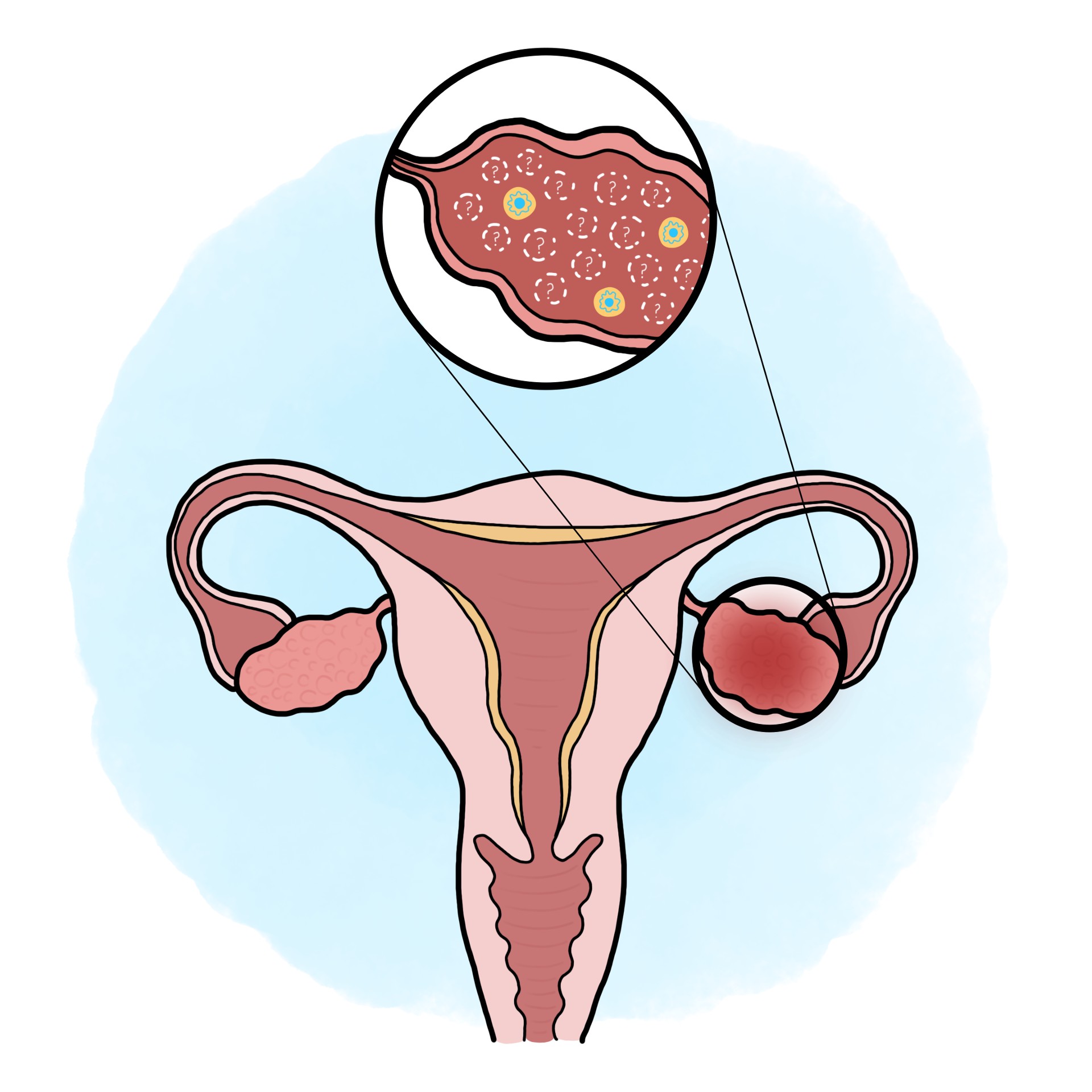 Premature ovarian insufficiency