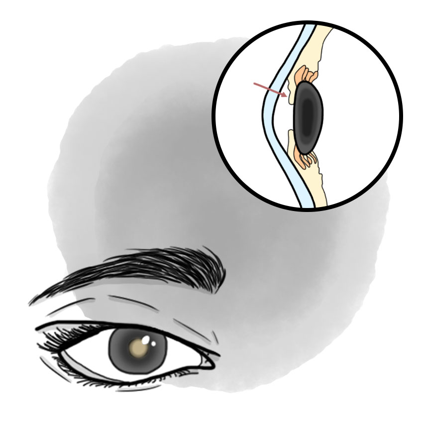 Acute closed-angle glaucoma