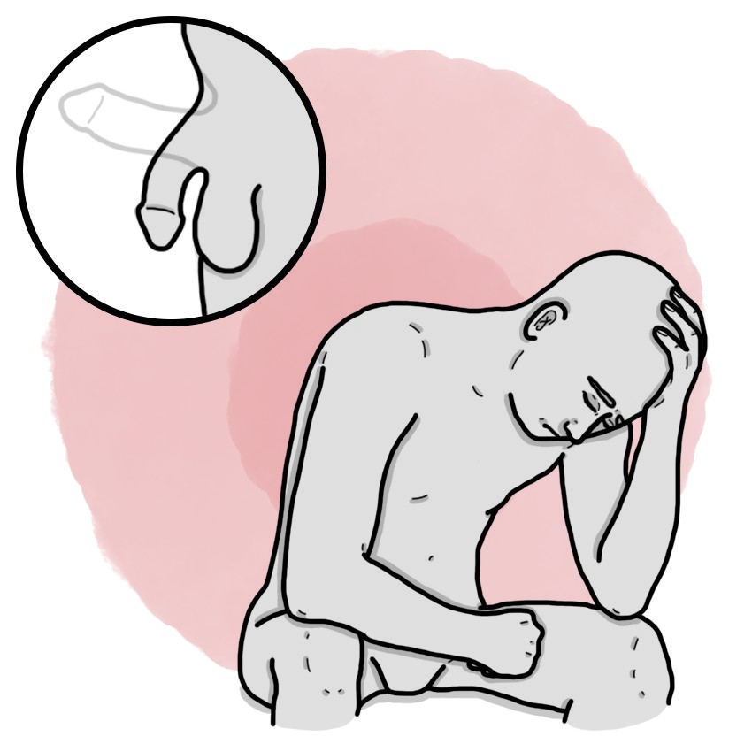 Erectile dysfunction