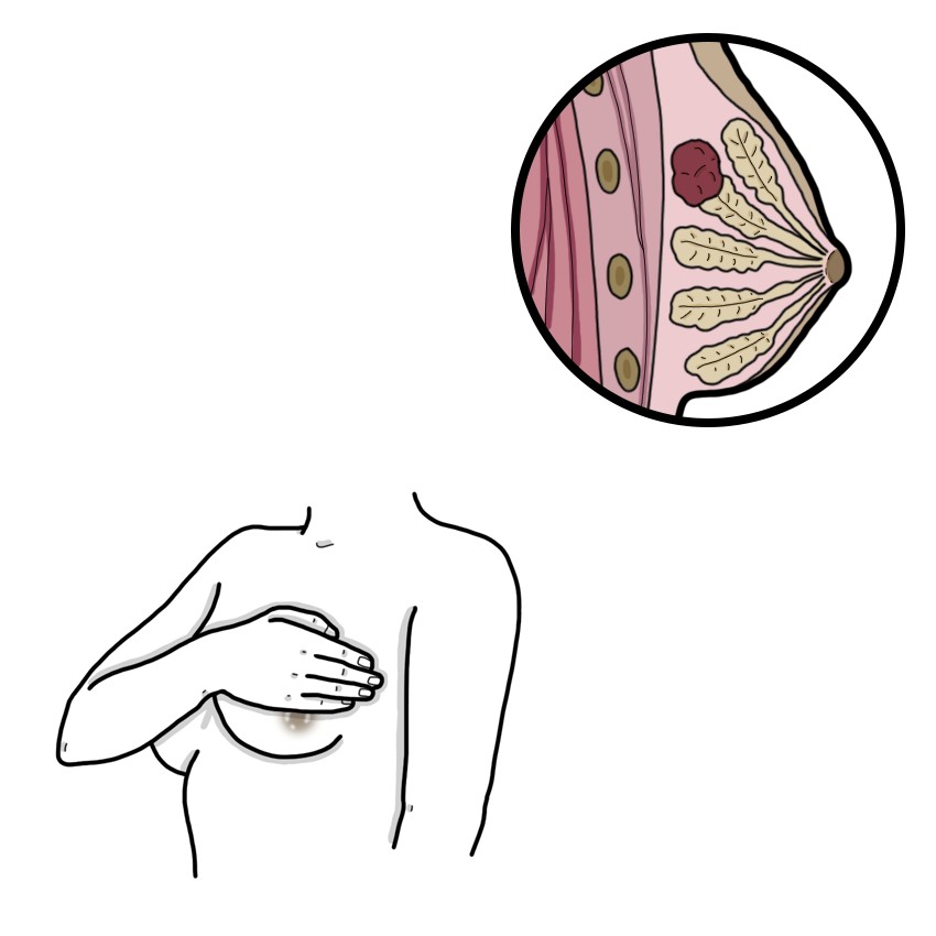 Fibroadenoma of the breast