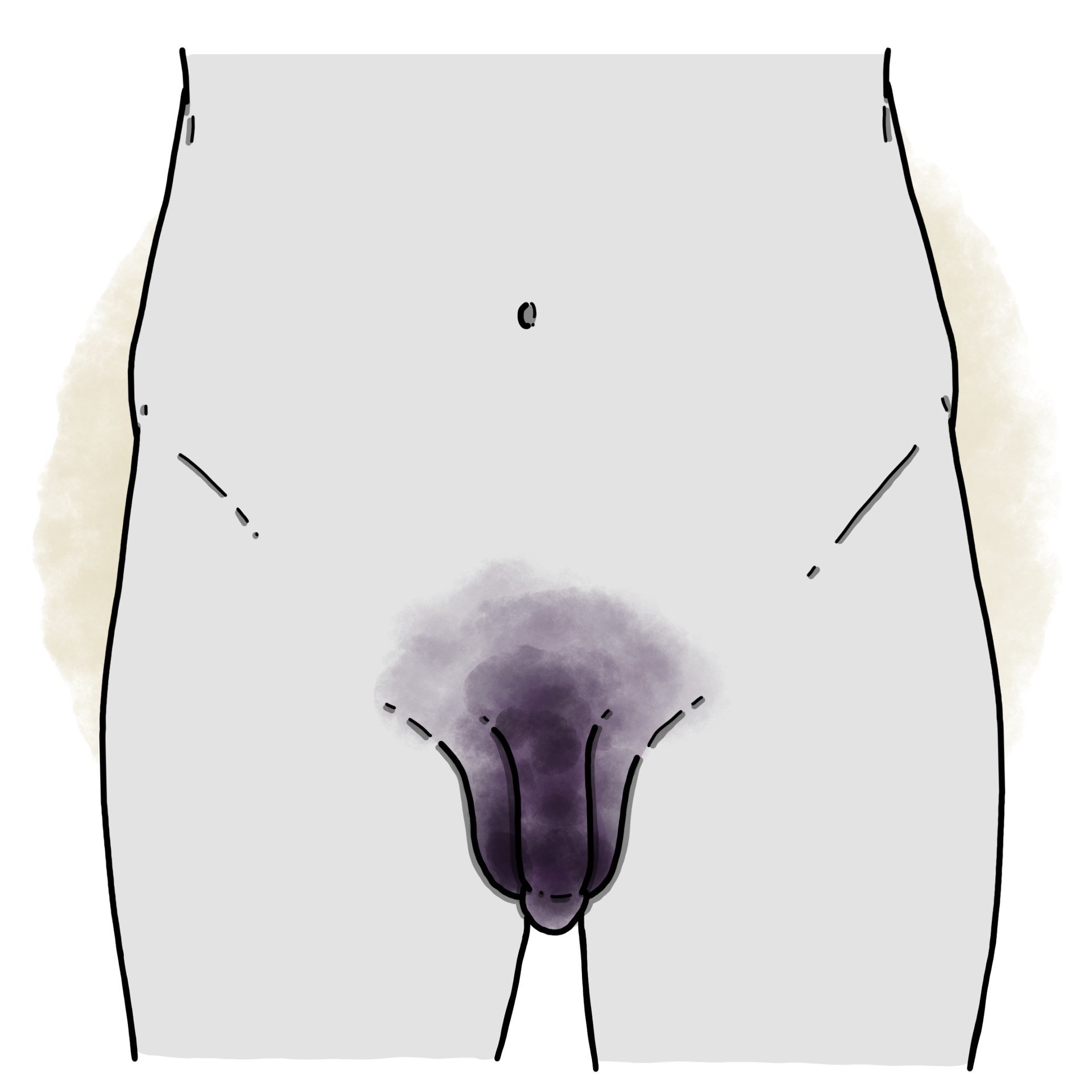 Genital / perineal necrotising fasciitis - Fournier's gangrene