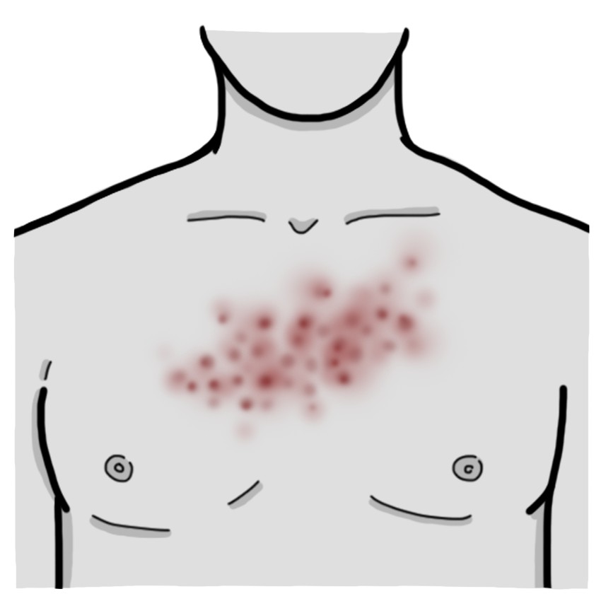 Torso rash