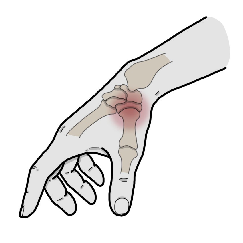 Dolor en base del dedo pulgar