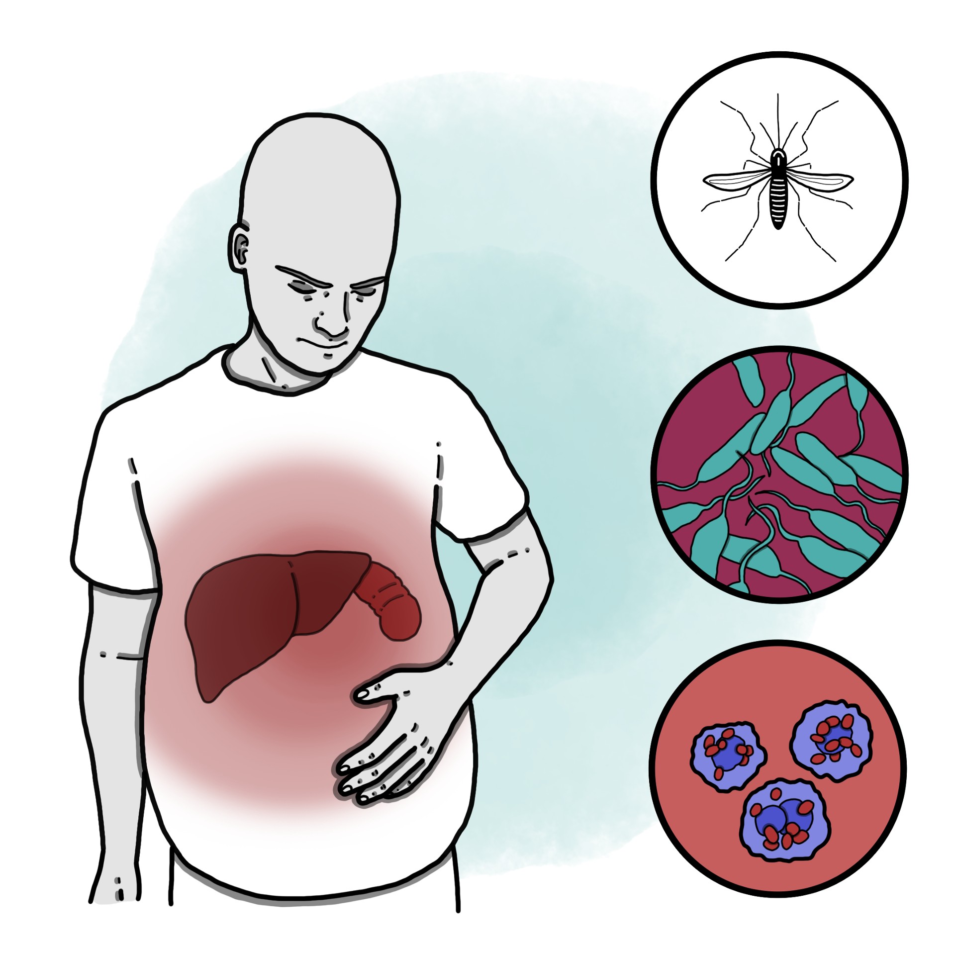 Visceral leishmaniasis - Kala-azar