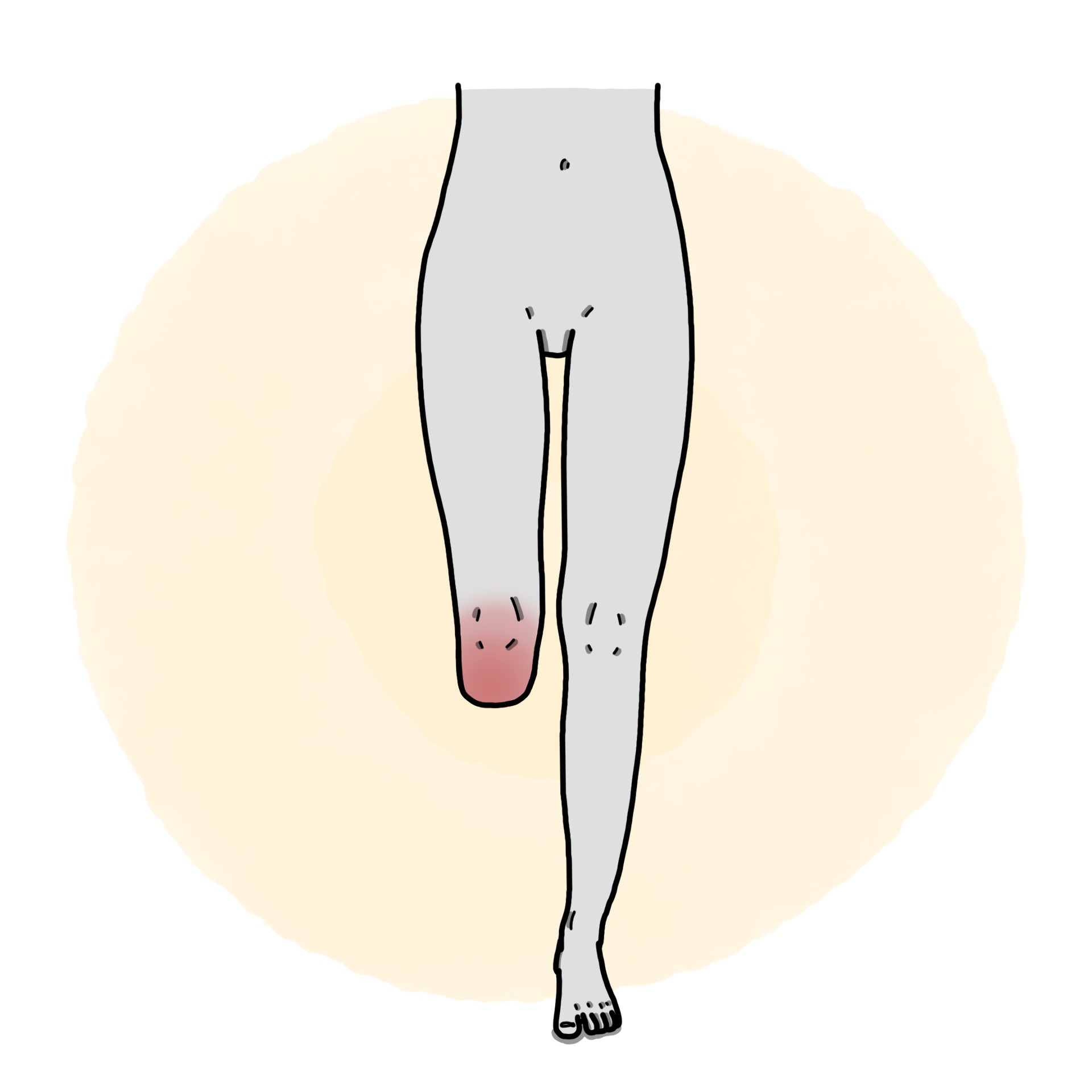 Lower leg amputation