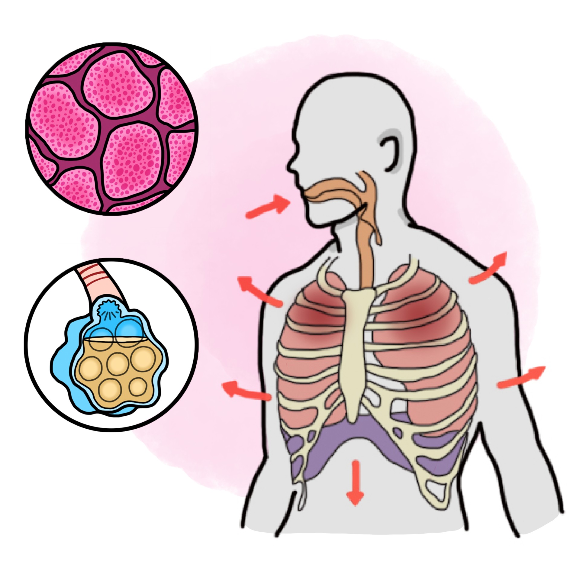 Aspiration pneumonia