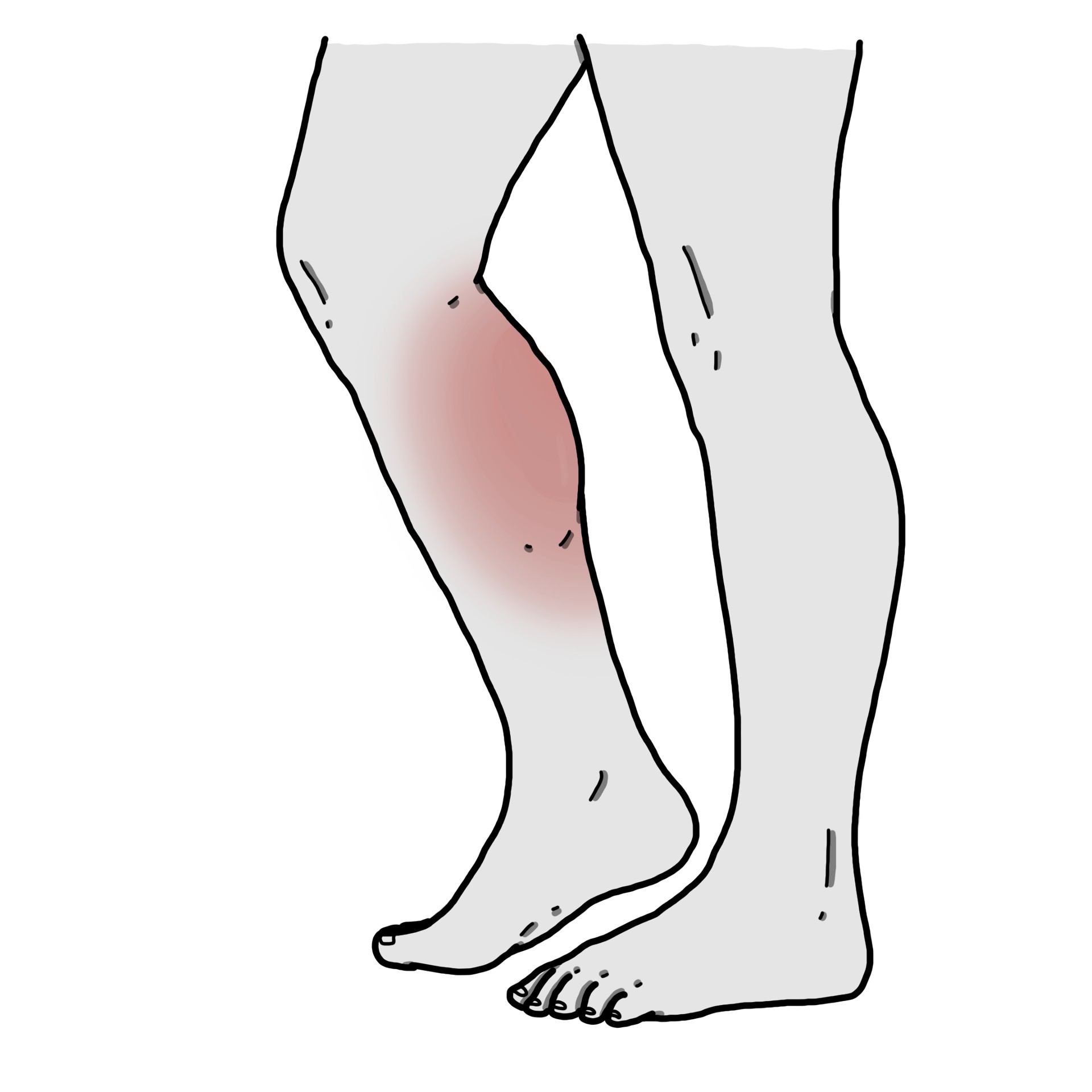 Intermittent claudication