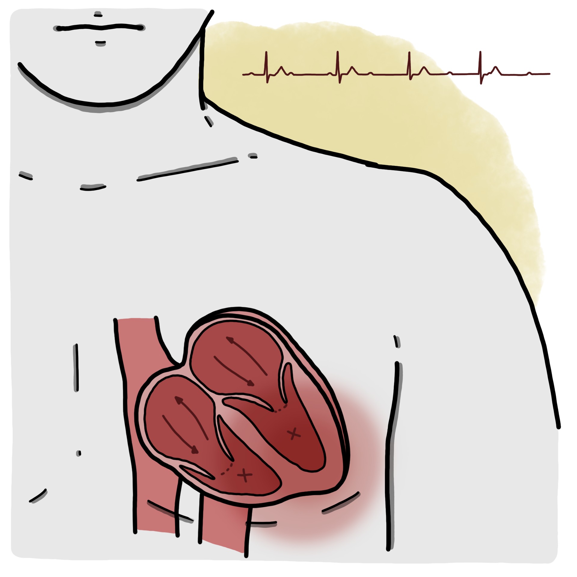 Third degree atrioventricular block (Paediatrics)