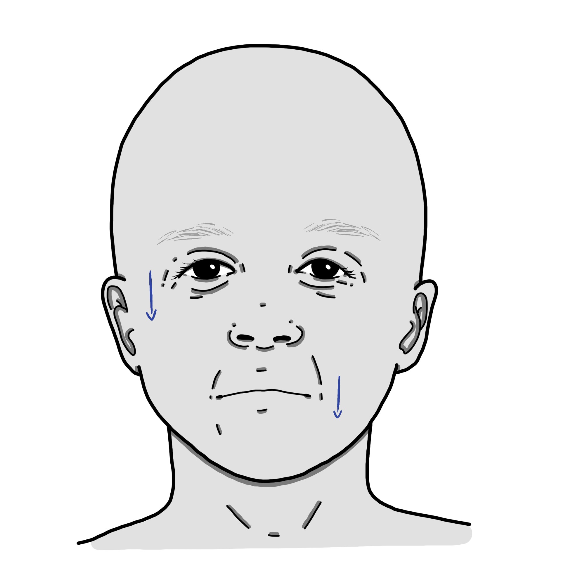 Paralysis or weakness in facial muscles