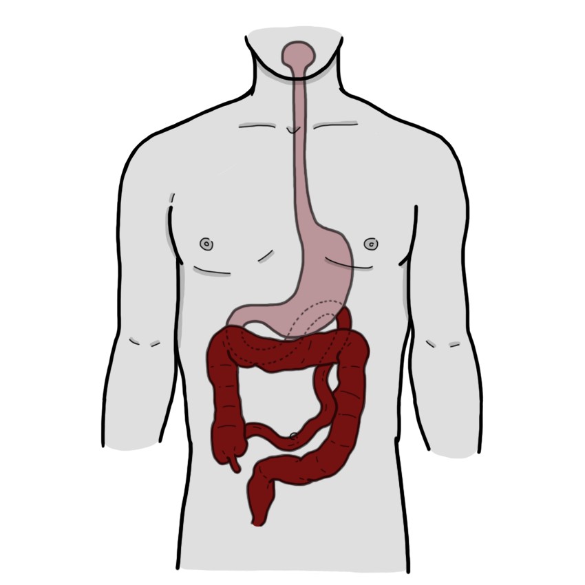 Lower gastrointestinal bleeding - Distal to the ligament of Treitz