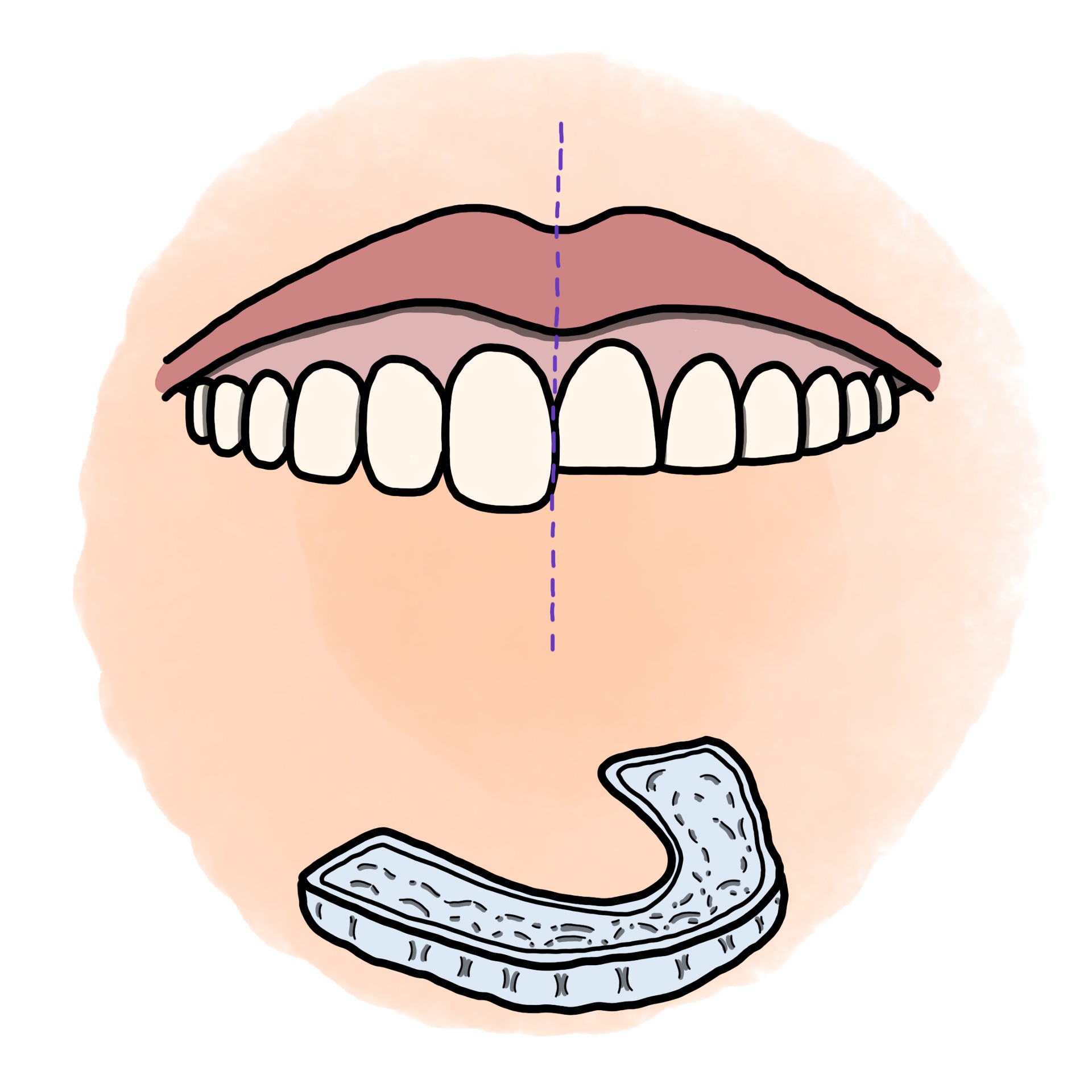 Teeth grinding - Bruxism