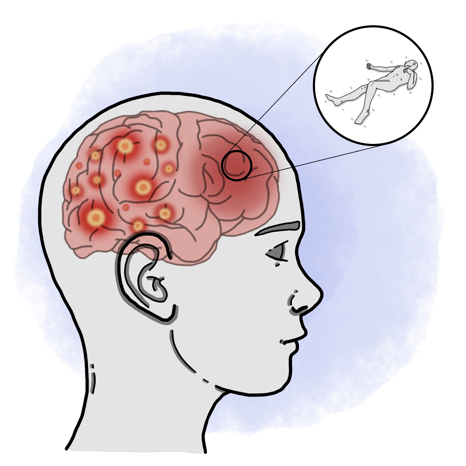 Epilepsy - Generalised tonic-clonic seizures (Paediatrics)