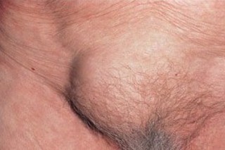 Abdominaler Leistenbruch