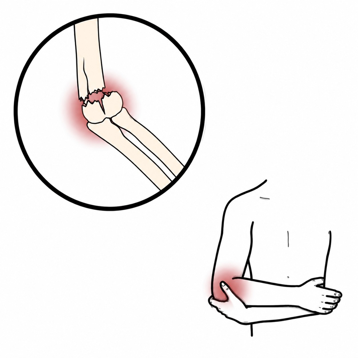 Elbow fracture