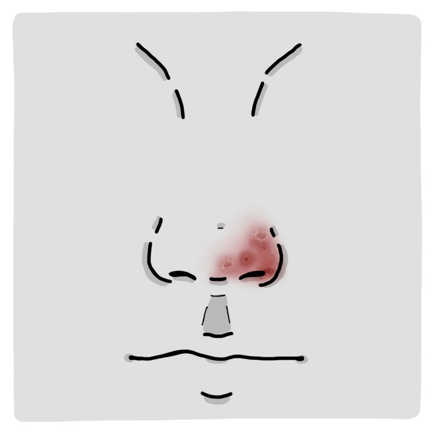 Úlcera nasal