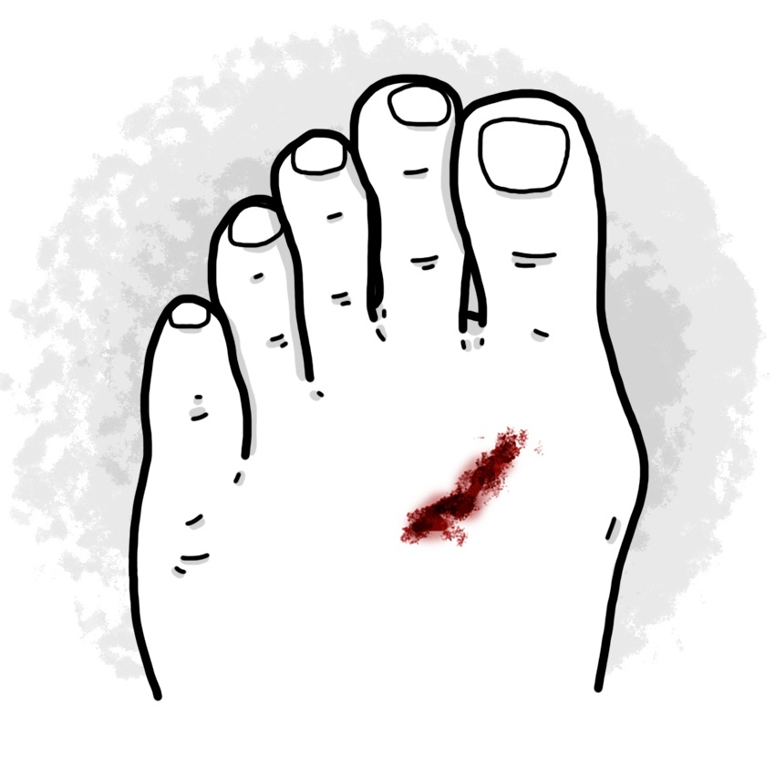 Foot wound