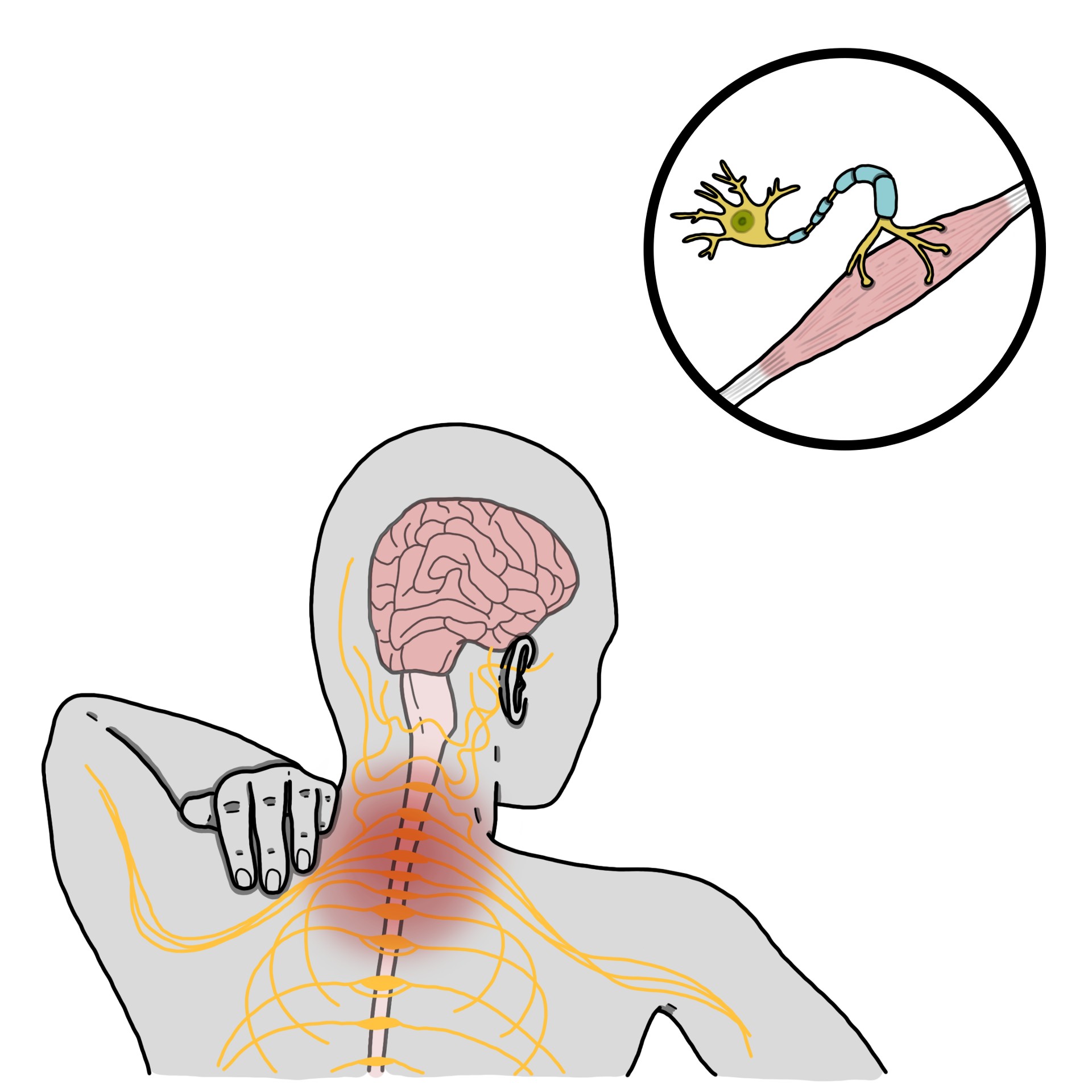 Amyotrophic lateral sclerosis