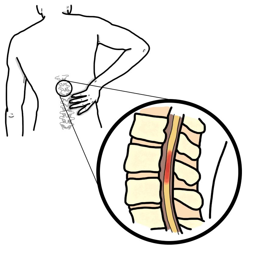 Transverse myelitis