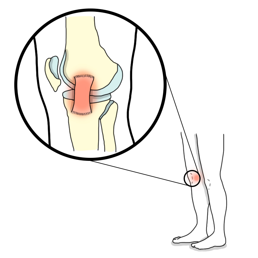 Medial collateral ligament (MCL) injury of the knee